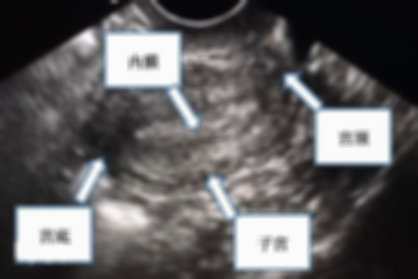 子宫内膜三线不清是移植失败的主要原因吗？对胚胎着床的影响解析