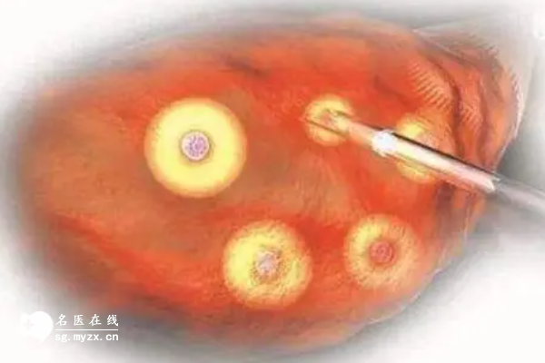 试管婴儿自然周期取卵是什么？3分钟带你全面了解