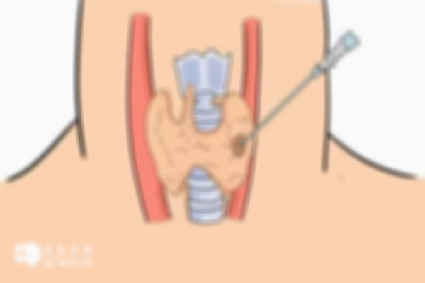 甲状腺结节能做试管婴儿吗？医生：对成功率并无太大影响