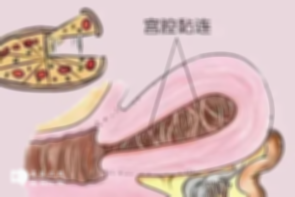 宫腔粘连患者分享试管婴儿成功经验，做好准备成功率不算低