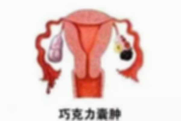 巧克力囊肿做试管婴儿成功率高吗？来这里一探究竟