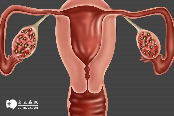 多囊卵巢不是只有试管才能怀孕？这些备孕方法也很有效