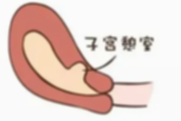 子宫憩室试管移植鲜胚如何提高成功率？只需要注意这些方面
