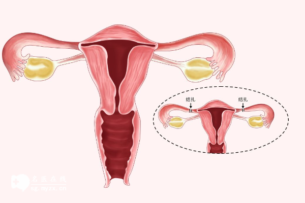 你知道试管婴儿结扎输卵管的原因吗？听医生告诉你详情