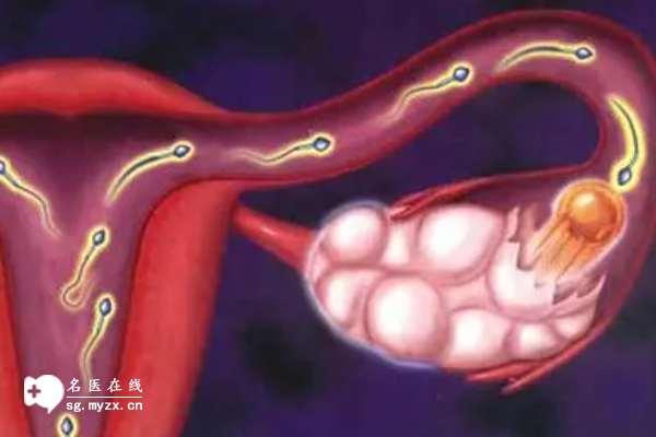 卵巢囊肿做试管的3种方案，方案选好孕气就来了