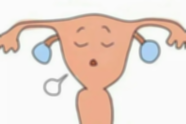 子宫憩室有积液也别慌张，采用试管或可解决