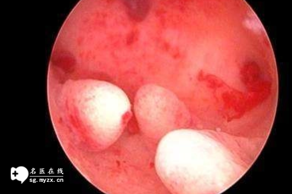 患有宫腔粘连的看过来，及早治疗避免感染