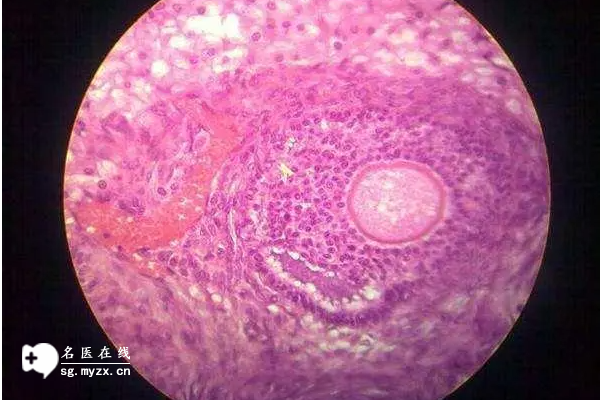 卵泡不破裂黄素化不用担忧，3种方法可助孕