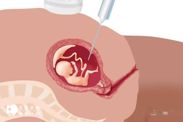 做三代试管羊水穿刺有原因，降低遗传病风险