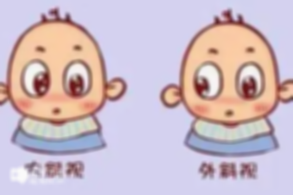 有内斜视基因能不能做三代试管排除？可以极大的降低风险