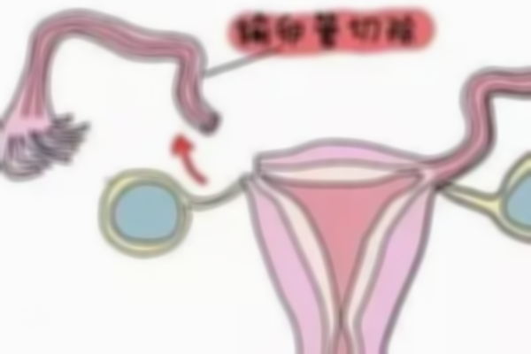 输卵管复通术需要花多少钱？费用明细全在这