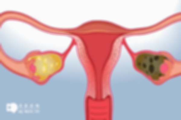 生理性卵巢囊肿做试管婴儿：注意这四点
