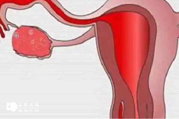 慢性子宫炎可能导致不孕，常见问题看这里