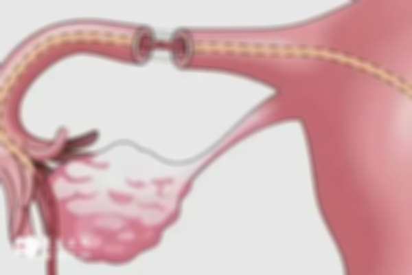 女性切除一侧输卵管后，自然怀孕和试管成功率均受影响