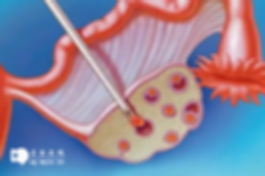 黄体期取卵成功率高吗？附优势及局限性详解