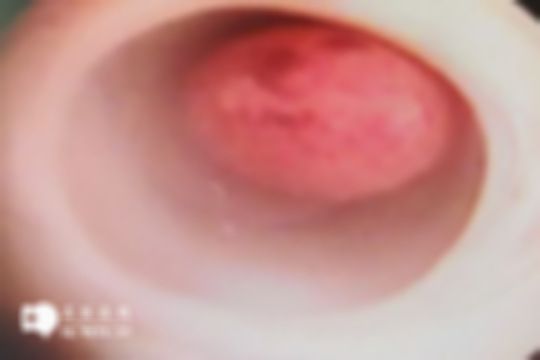 宫腔息肉影响试管婴儿移植吗？附助孕方法分享