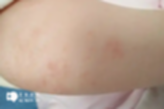 宝宝湿疹有6大技巧，缓解宝宝不适更轻松！