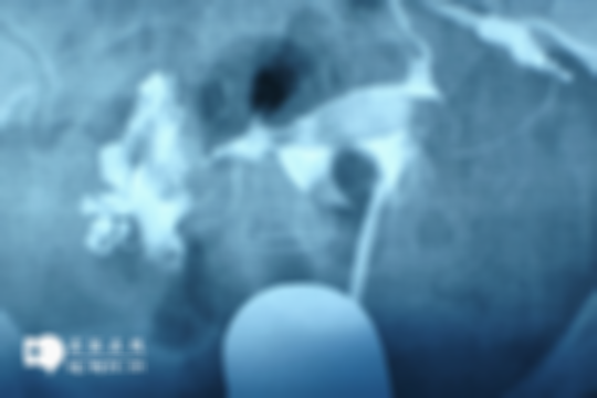 试管前为何要做输卵管造影检查？竟是为了提高受孕率