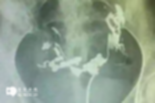 输卵管造影后的备孕时间因人而异，注意这5点即可
