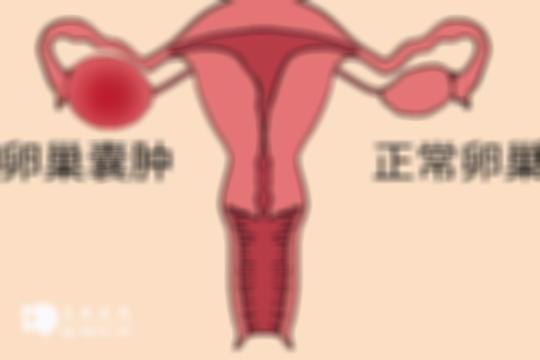 造成卵巢囊肿的四大原因分析，有困扰的速来看