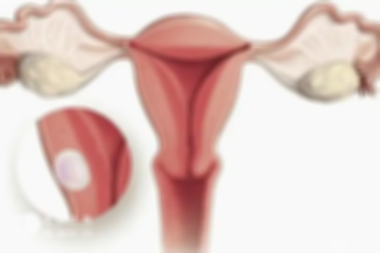 子宫腺肌症怀孕后该如何保胎？这3大方法赶紧收藏