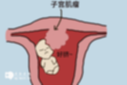 备孕期间发现子宫肌瘤该怎么处理？建议听取医生指导