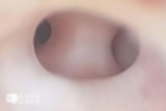 宫腔粘连形成的原因多种多样，能否生育要看严重程度