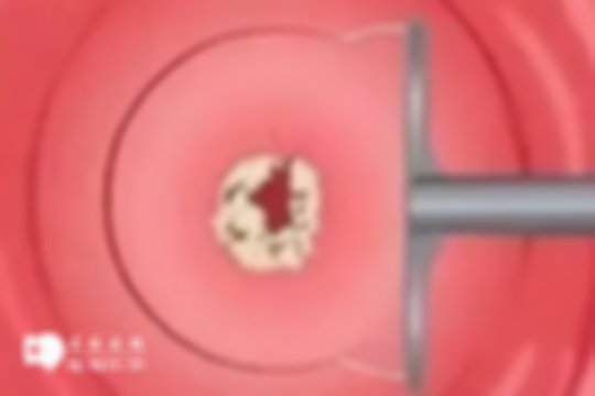 剖腹产后宫颈口向右变歪会影响怀孕吗？附应对措施