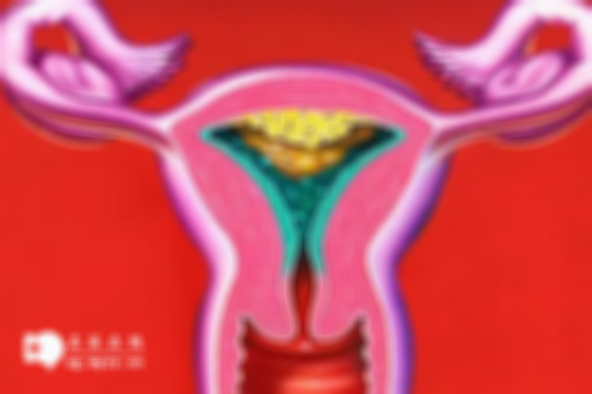 残角子宫一般不需开腹手术，想要受孕仍有机会