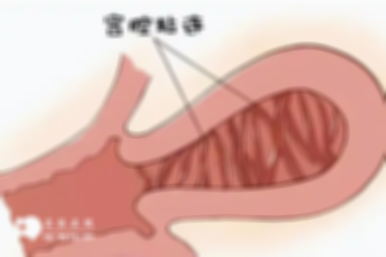 宫腔粘连不及时治疗能否自愈不好说，预防方法一手掌握