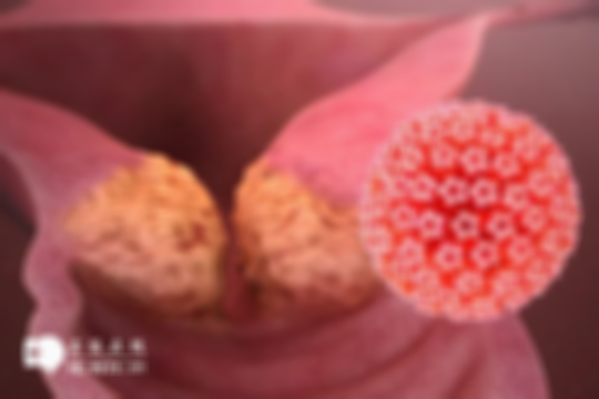 女性感染HPV的早期症状表现分别是哪些？解读症状及预防措施