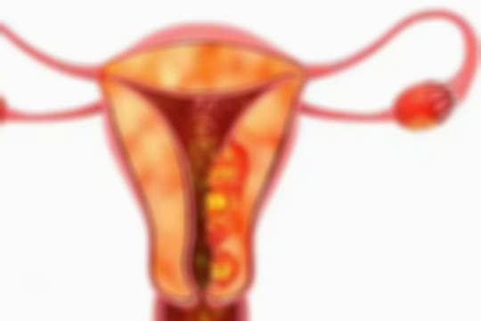女性子宫腺肌症的症状-子宫腺肌症常见的五种表现一览