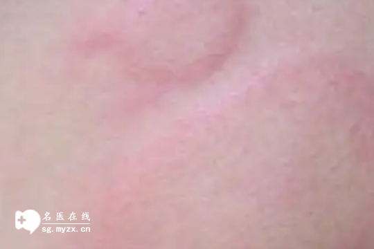荨麻疹最怕的三大土方法，帮助消退有效果，错过后悔！