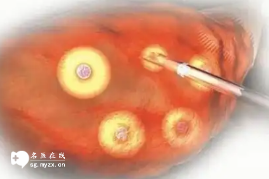 揭秘：取卵后排腹水的绝招，具体方法看这篇足够了