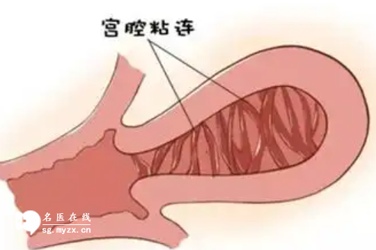 患有宫腔粘连的女性看过来，早发现、早治疗呵护健康！