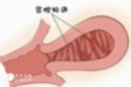 患有宫腔粘连的女性看过来，早发现、早治疗呵护健康！