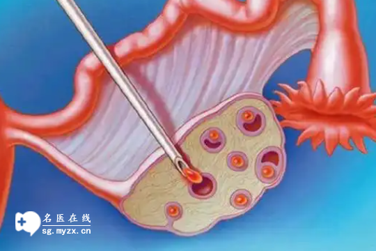  取卵后打麻药对身体的影响要看个体情况，个别人会出现恶心反应