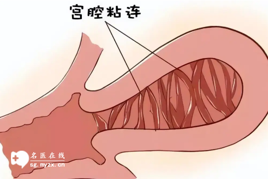 宫腔粘连对女性身体的影响：不孕、月经不调等较常见