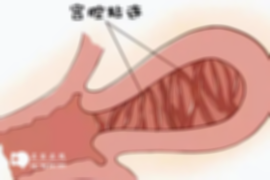 宫腔粘连对女性身体的影响：不孕、月经不调等较常见