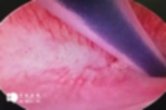 宫腔环境不佳会影响着床率吗？医生建议：试管前做宫腔镜检查