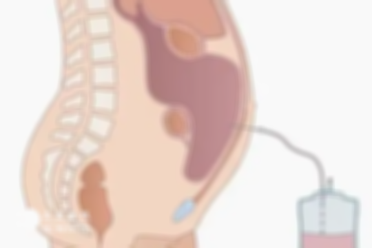 腹水高峰期一般取卵后第几天？一般3-5天，文中有更多解答
