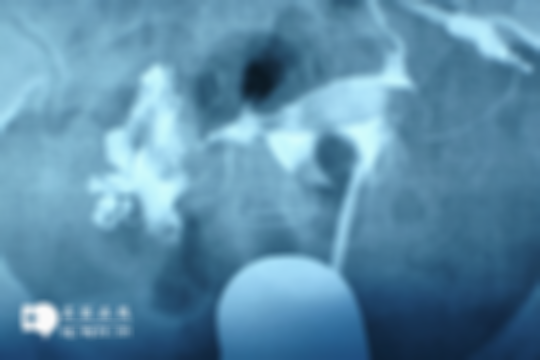 真的不骗你！输卵管造影千万别轻易做，关于它的5大危害可得来瞧瞧