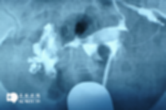 做输卵管造影前，你需要知道这些：四类人群尽量避开！