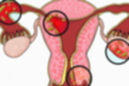面对子宫内膜异位性不孕症，除了手术，还有这4种治疗方法值得了解一下！