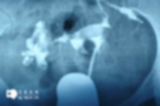 女性做输卵管造影检查痛不痛？术后至少要休息几天？专业解答来啦！