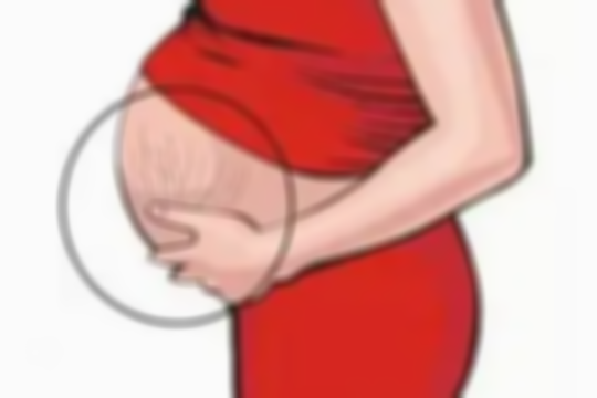 白色妊娠纹VS红色妊娠纹，颜色差异暗藏什么？出现时间+治疗攻略，必读！