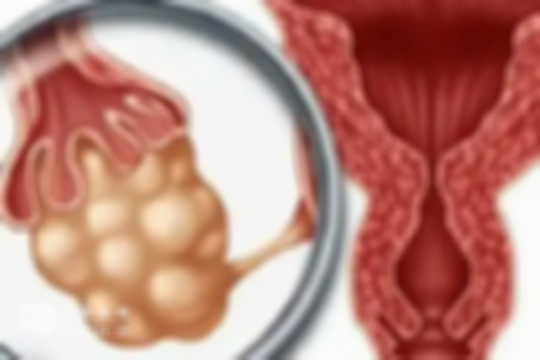 红薯竟是多囊卵巢的“隐藏救星”？想不到吧，吃法找对，囊肿快速改善！