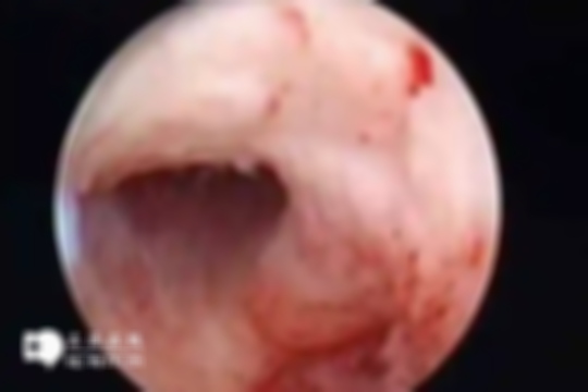 女性健康提醒：宫腔粘连的 5 大常见征兆一览，腹痛、月经异常别忽视，尽早治疗！