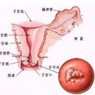 宫颈糜烂